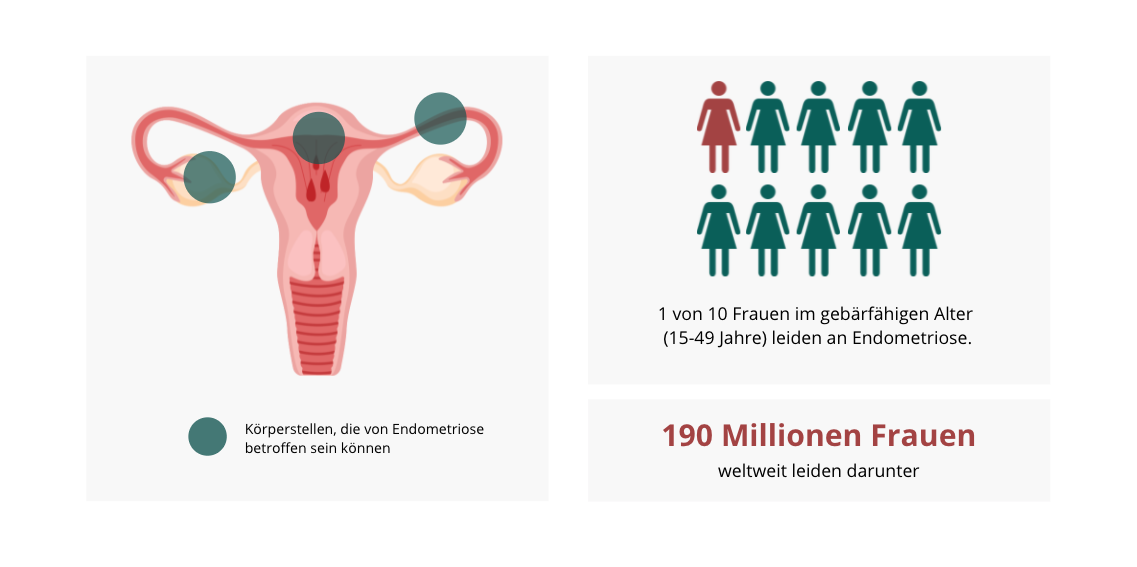 Endometriose und Unfruchtbarkeit | Der Fruchtbarkeits Blog